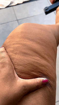 Mulher com dor nas pernas ao acordar, sintoma comum do lipedema