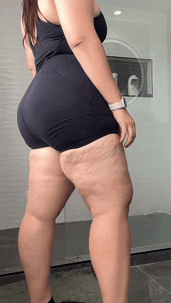 Deformidades visíveis nas pernas, estágio 3 do lipedema