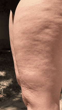 Pele irregular com aspecto de casca de laranja, estágio 2 do lipedema