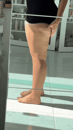 Pernas inchadas com pele ainda lisa, estágio 1 do lipedema